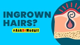 ANY ADVICE FOR INGROWN HAIRS?