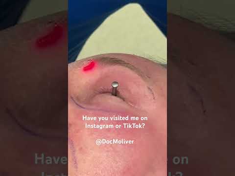 Fractional CO2 laser resurfacing.