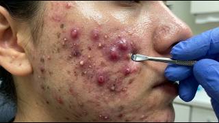 Loan Nguyen Acne Treatment 20zz