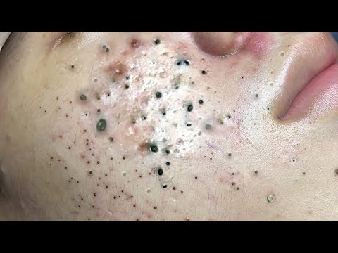 Big Cystic Acne Blackheads Extraction Blackheads & Milia, Whiteheads Removal Pimple Popping # 46691