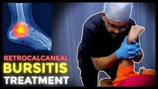 HEEL Pain बिना Surgery Cure हुआ AMAZING Chiropractic Treatment से Relief मिला