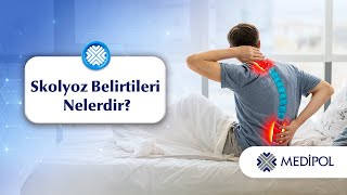 Skolyoz Belirtileri Nelerdir?│Prof. Dr. Mustafa Özdemir