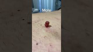 Mole #skincare