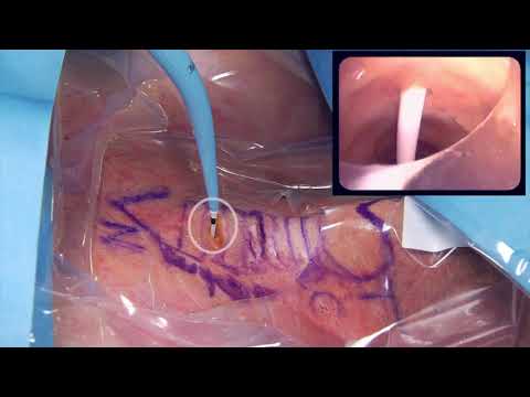 percutaneous tracheostomy ciaglia