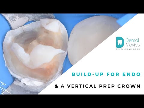 Build up for endo & a vertical prep crown