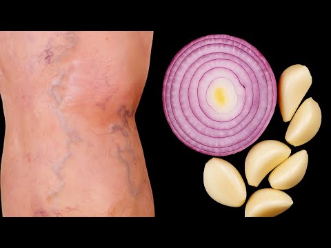 Say Goodbye to Varicose Veins with These Natural Fixes!