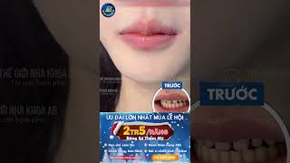 Clip Dán sứ Veneer T11 final 1