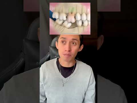 como reemplazar un diente faltante