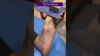 Foot corn removal #drhemayadav