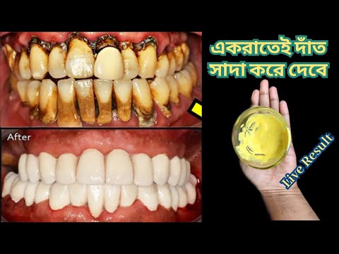 ১ রাতেই দাঁতের পাথর গলিয়ে দেবে | দাঁতের কালো ভাব দূর করার নতুন পদ্ধতি | teeth whitening home remedy