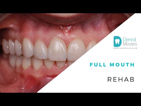 Full mouth rehab