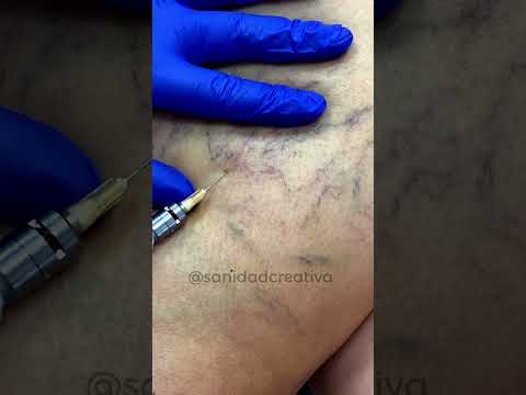 Cómo ELIMINAR VARICES con ESCLEROTERAPIA