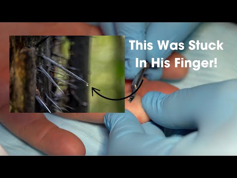 Palm Tree Spike Removal