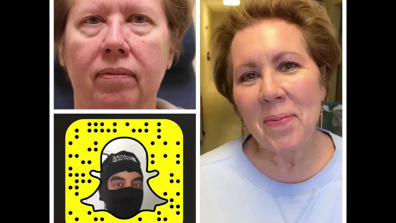 Before and after transformation with Snapchat filter.
