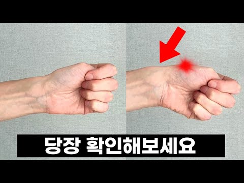 이거 방치하면 곧 손목이 망가집니다 (당장 손 확인하세요)