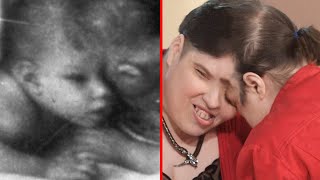 The Dark History of Conjoined Twins