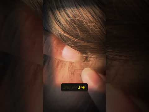 من معاني القمل في المنام #تفسير_الاحلام