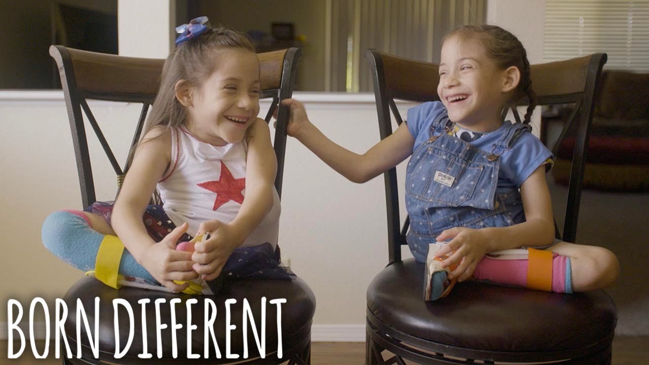 The conjoined twins who were separated - born different