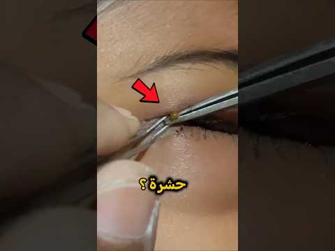 شعرت بشيء داخل عينها؟ 😱😨‼️
