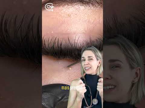 Conhece Milium? Médica Explica!