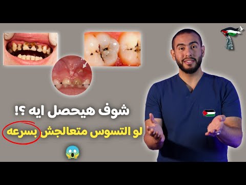 للمره المليون لو ضرسك بطل يوجعك مش معناها انك خفيت | مراحل تسوس الاسنان | علاج تسوس الاسنان