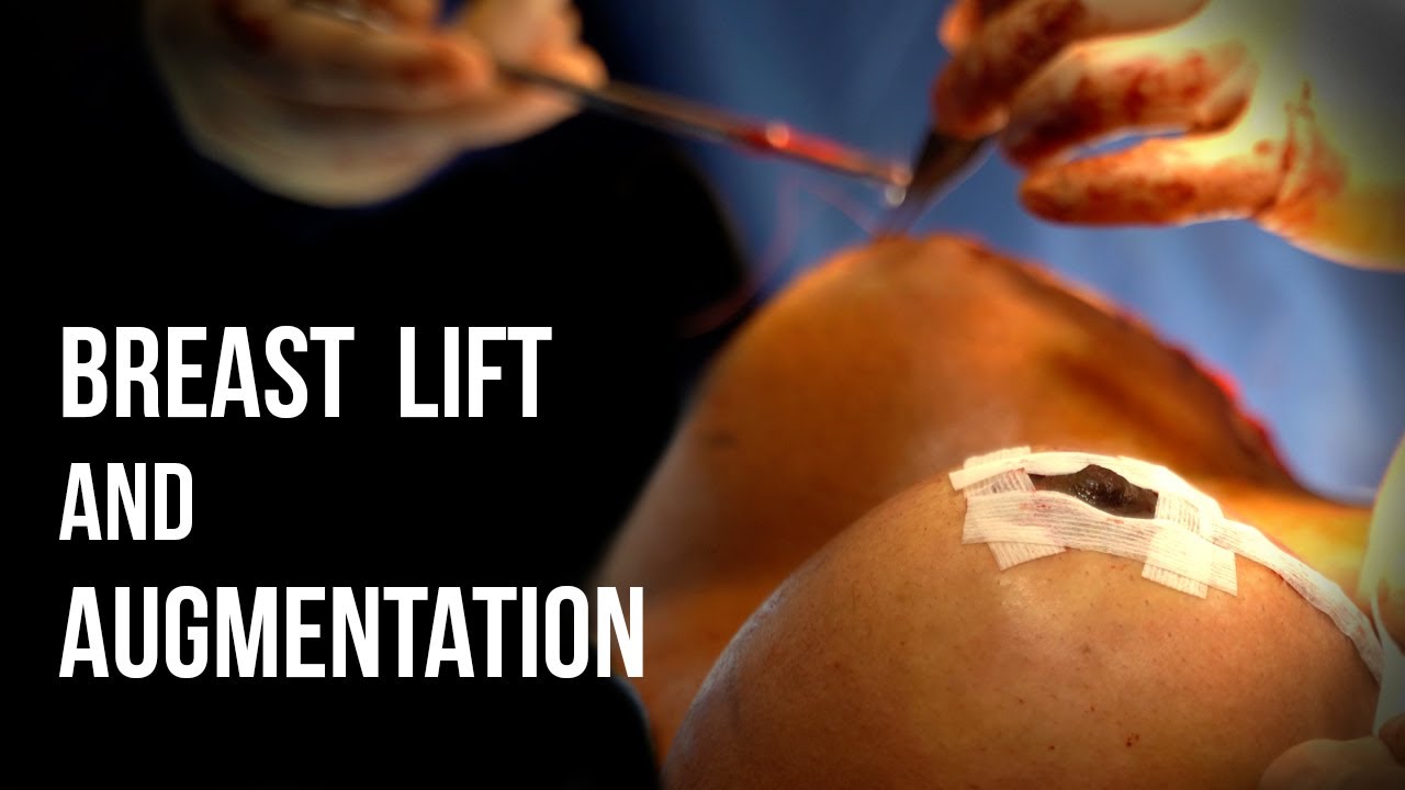 Surgical breast lift and augmentation procedure.