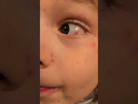 4 ans . Un bouton dans l'œil