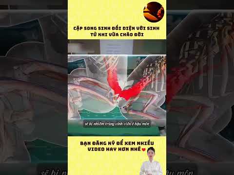 Cặp song sinh đối diện với sinh tử khi vừa chào đời #shortvideo