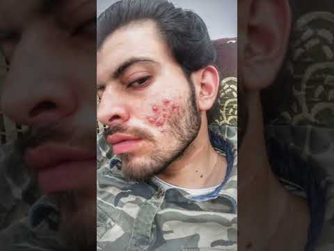 30 Din Mein Acne Gayab Acnestar Gel | I Used Acnestar Gel 30 Days Acne Transformation #shorts #acne