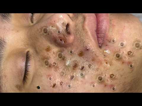 𝑪𝒚𝒔𝒕𝒊𝒄 𝑨𝒄𝒏𝒆 𝑹𝒆𝒎𝒐𝒗𝒂𝒍 & 𝑰𝒏𝒇𝒍𝒂𝒎𝒎𝒂𝒕𝒐𝒓𝒚 𝑨𝒄𝒏𝒆 #𝟖𝟔𝟖𝟔𝟔𝟗