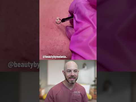 This cheek blackhead is ready to make its grand exit today! 👋 (credit: @beautybymelania_ on TT) #fyp