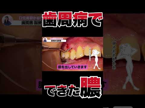 歯周病で取り返しのつかない病気に！？