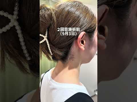 施術後について🤗 #うなじ脱毛