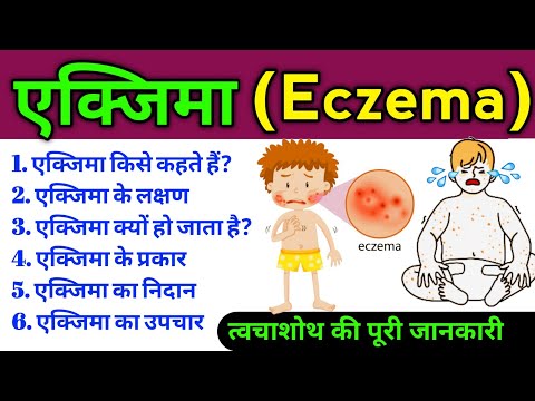 एक्जिमा रोग (Eczema disease) | एक्जिमा के लक्षण, कारण, बचाव, निदान, उपचार | all about Eczema disease