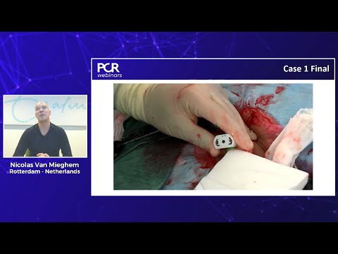Optimizing procedural outcomes of TAVI in challenging anatomies – Webinar