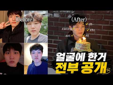 얼굴에 한 거 전부 공개합니다(시술부터 성형까지)