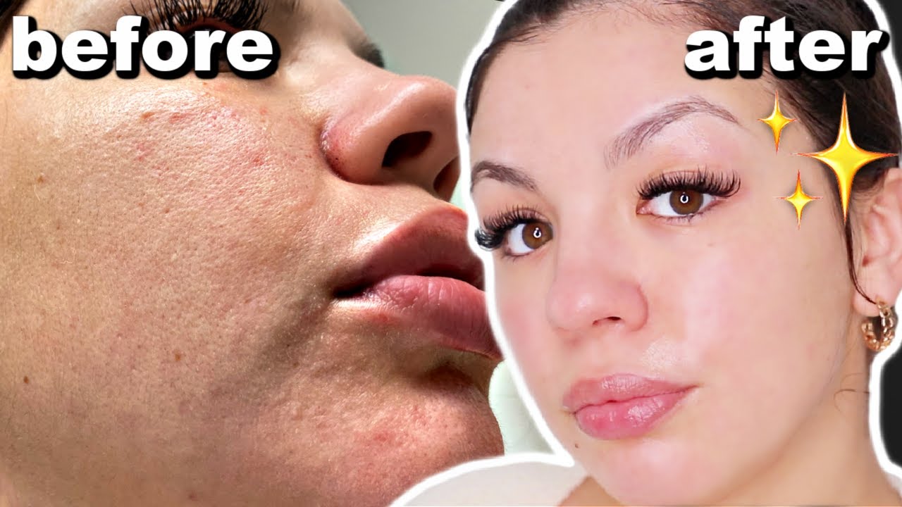 How to get rid of dry and textured skin - skincare routine - Audrey Victoria