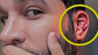 MINHA ORELHA FICOU IGUAL DE LUTADOR DEPOIS DA CIRURGIA 👂 MUUUITO INCHADA, ATÉ ASSUSTEI...