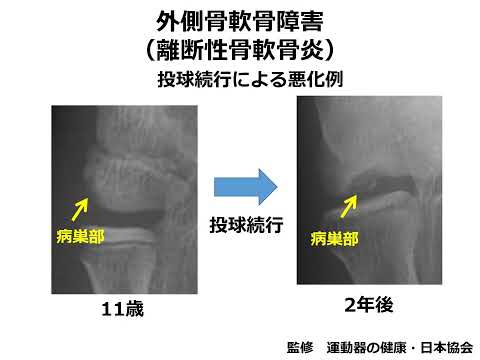 「スポーツ障害から子供達（スポーツ選手）を守る」　理学療法学専攻　教授　田鹿毅