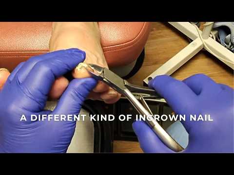 She Thought It Was Vertigo... It Was Actually a Stroke 😳 | A Different Kind of Ingrown Nail, Painful
