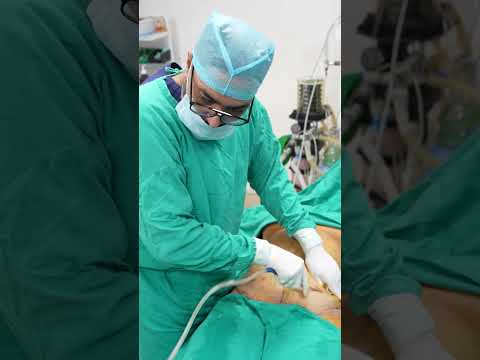 Liposuction Surgery #abdomen #tummy #shorts #ytshort