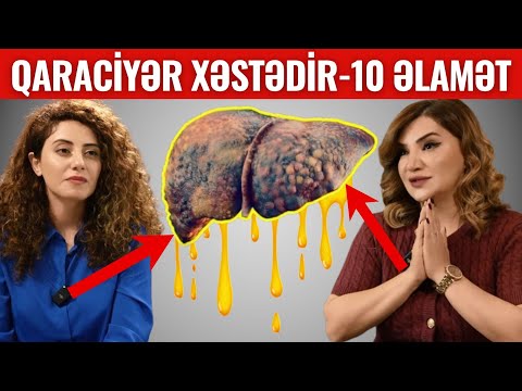 Qaraciyəri ÖLDÜRƏN Qidalar - Qaraciyərin Öldüyünü Göstərən 14 Əlamət!