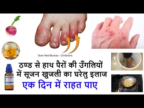 ठंड में हाथ पैरों की उंगलियों मे सूजन व खुजली के घरेलू इलाज़ Home Remedies for Chilblains, Perniosis