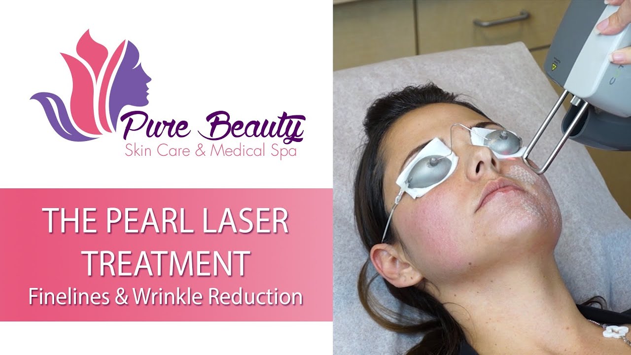 Pearl laser treatment for wrinkles and fine lines.