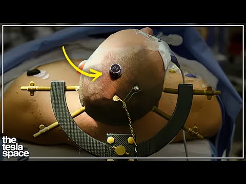 Neuralink Reveals First Human Patient!