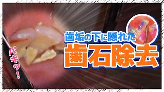 うがいじゃ取れない歯垢と歯石‼️Dental plaque and tartar that cannot be removed by gargling