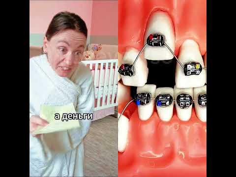 #braces #bracesoff #funny #foryou