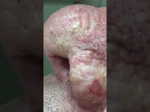 #Throwback to 'Mr  Wilson' and his amazing blackheads