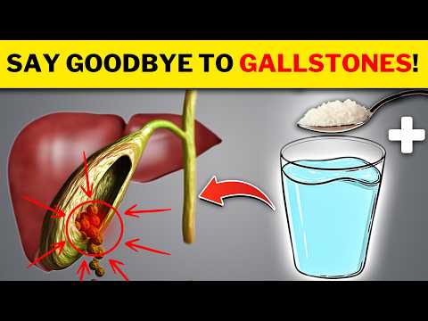 Dissolve Gallstone Naturally: Causes & Cure