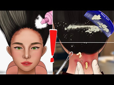 ASMR Satisfying Scalp Scaling Care Animation‼️Get rid of tons of head licd, Blackhead